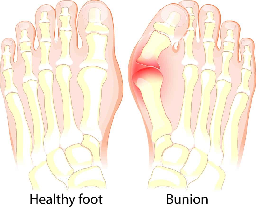 Bunions - Trinity Foot Center