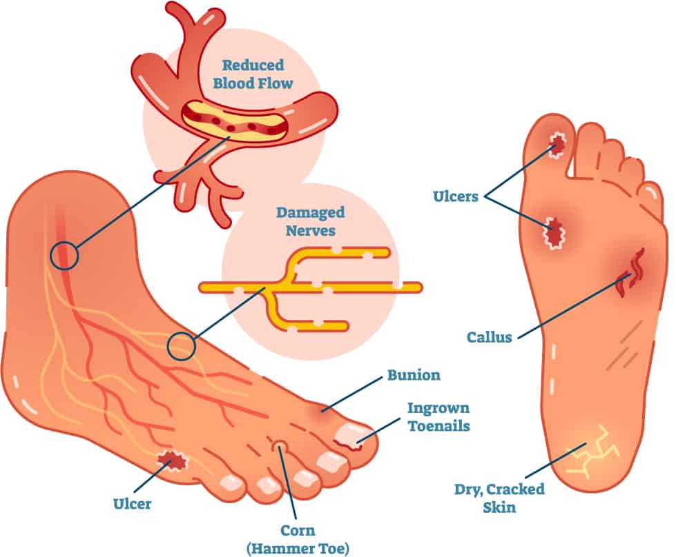 diabetic-foot-care-diagram