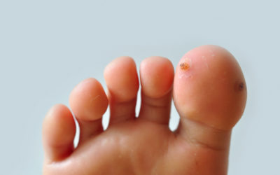How to Finally Get Rid of Your Foot Warts