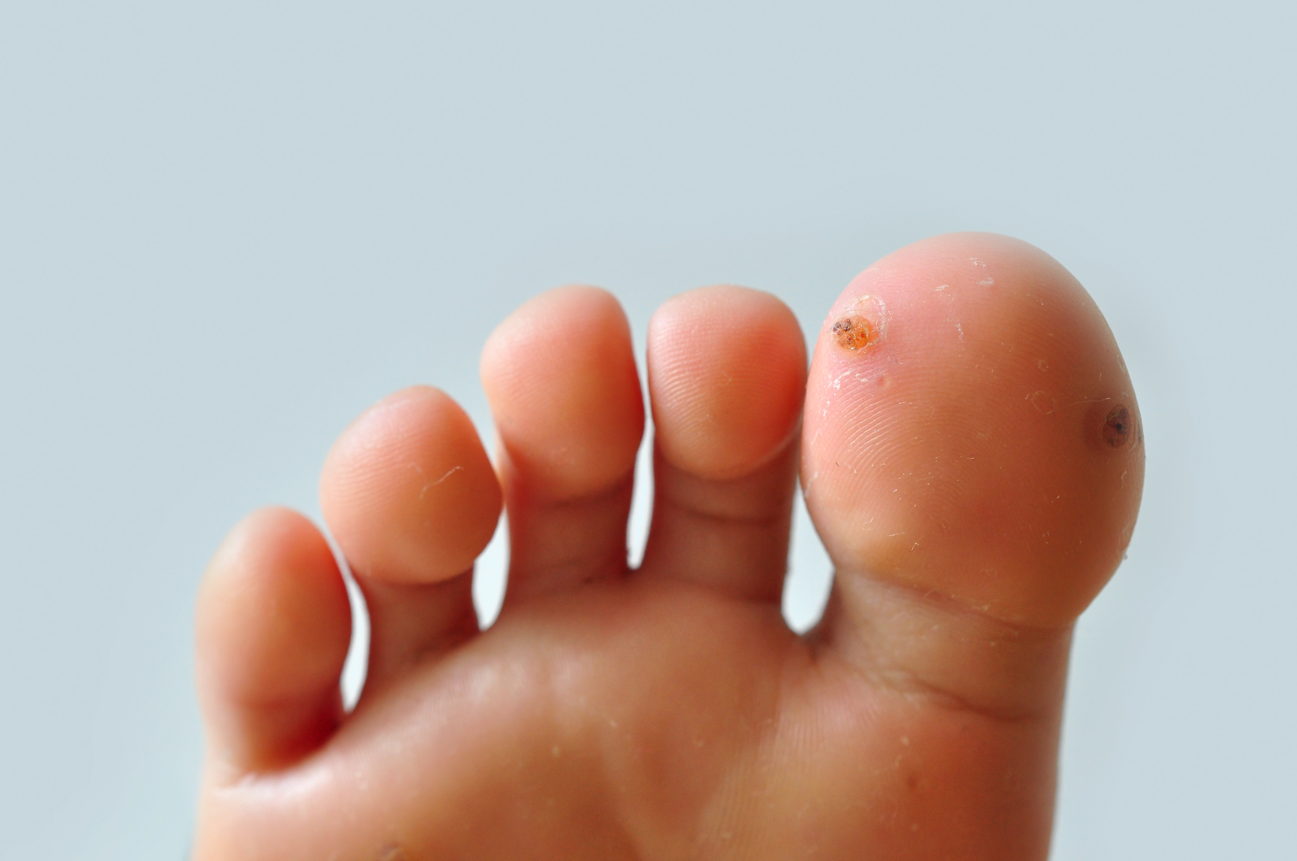 How To Finally Get Rid Of Your Foot Warts Trinity Foot Center