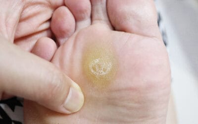 What (and What NOT) to Do About Your Corns or Calluses