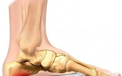 Don’t Fall for these 6 Causes of Heel Pain