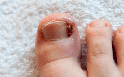 Preventing and Treating Ingrown Toenails